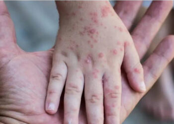 No concern yet monkeypox will cause pandemic: WHO