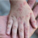 No concern yet monkeypox will cause pandemic: WHO